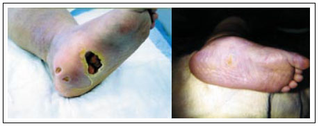 diabetic foot ulcer before and after treatment